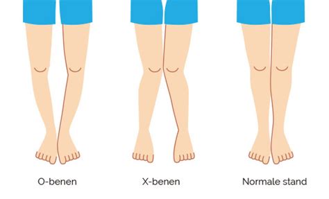 illustratie van normale beenstanden bij kinderen (O-benen en X-benen)