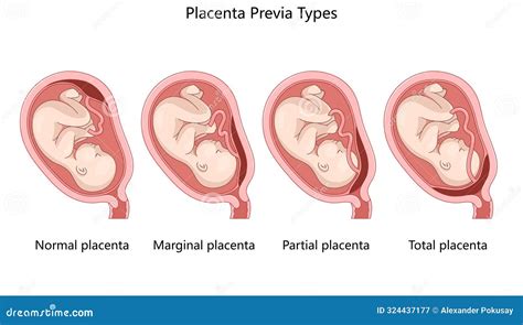 Diagram dat de verschillende posities van de placenta toont, inclusief placenta previa.