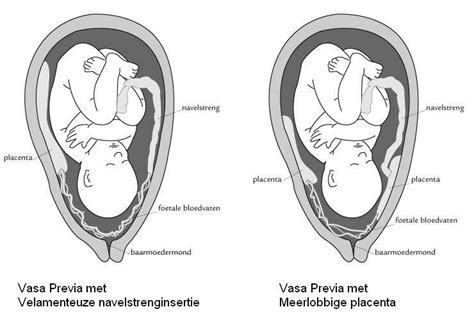 Visuele weergave van vasa praevia, waarbij bloedvaten de baarmoedermond bedreigen.
