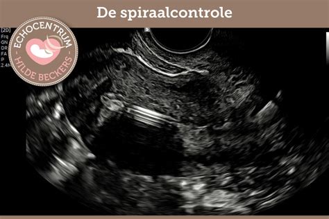 Schematische weergave van een placentalokalisatie echo, met nadruk op de inwendige meting.