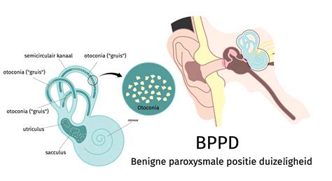 Illustratie van de Epley-manoeuvre voor de behandeling van BPPD.