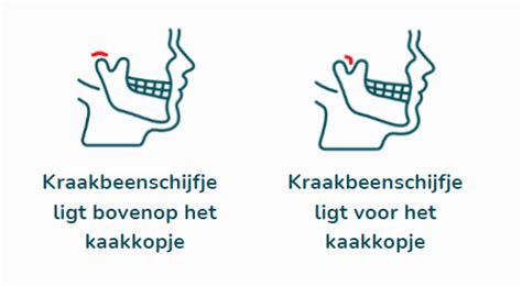Visuele weergave van een normale kaak versus een door spenen vervormde kaak, met nadruk op de tanden die scheef staan door ruimtegebrek.