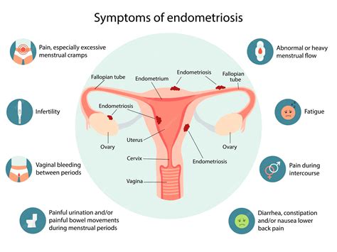 diagram dat de mogelijke oorzaken en symptomen van endometriose weergeeft