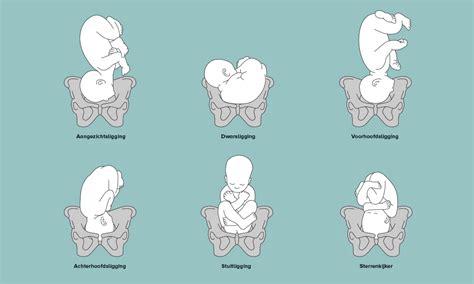 Illustratie van een baby in stuitligging in de baarmoeder.