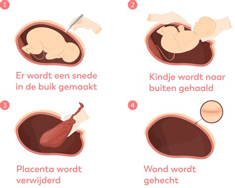 Schema met de stappen van een (geplande) keizersnede en mogelijke momenten van contact met de baby.