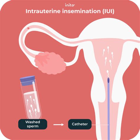 Infographic die het proces van IUI uitlegt