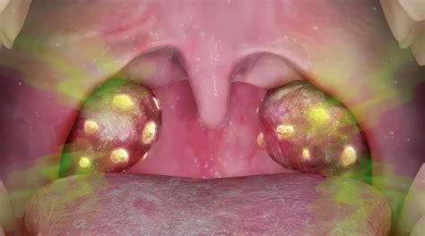 Diagram dat de oorzaken van slechte adem toont, met nadruk op bacteriële activiteit in de mond.