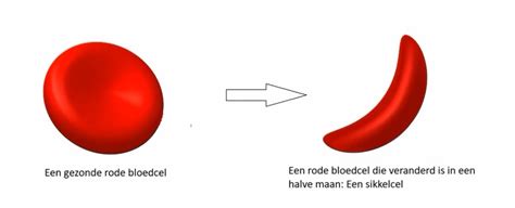 Illustratie van rode bloedcellen, met nadruk op de sikkelvorm bij sikkelcelziekte.
