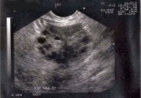 Echografie van eierstokken met cysten, kenmerkend voor PCOS