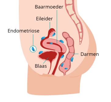 Illustratie van endometriose met zichtbare cysten