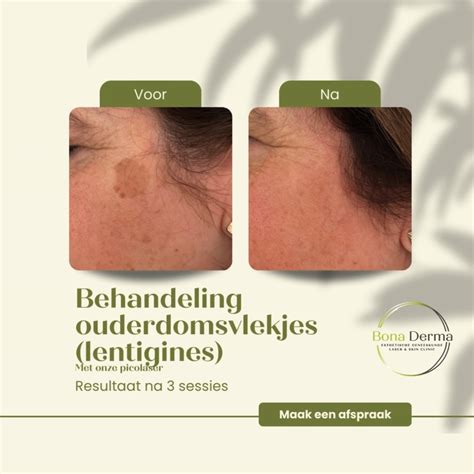 vergelijkingstabel van sproeten, lentigines en geboortevlekken