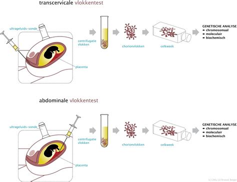 Schematische weergave van het uitvoeren van een vlokkentest via de buikwand