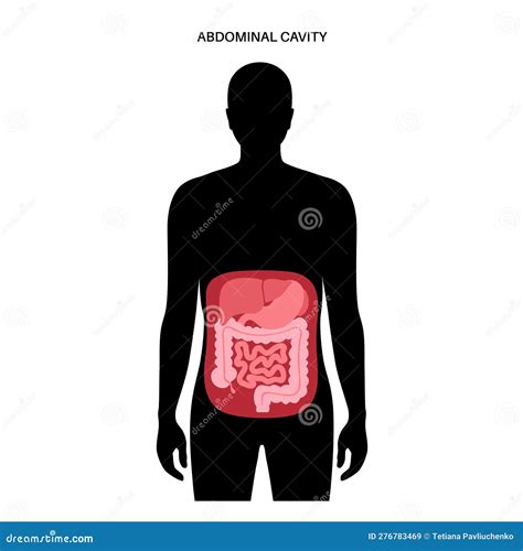 Illustratie van verklevingen in de buikholte, die organen aan elkaar trekken.