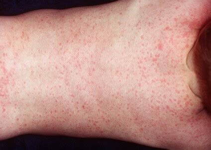 Detailfoto van de niet-jeukende, roze vlekjes van de zesde ziekte op de huid van een kind.