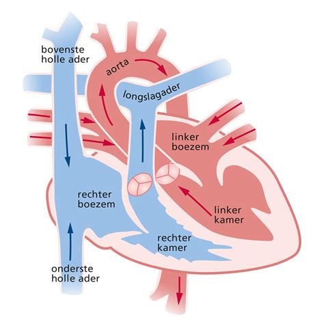 Diagram van een ventrikelseptumdefect (VSD) met pijlen die de abnormale bloedstroom aangeven.