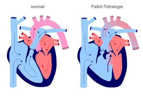 Illustratie van de vier componenten van de Tetralogie van Fallot.