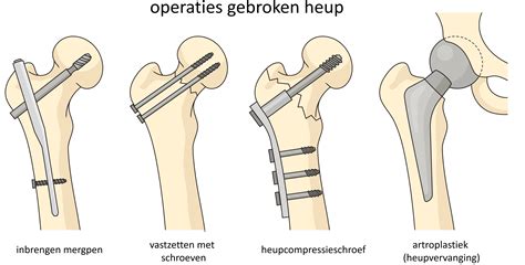 Schema van de stappen na gebroken vliezen