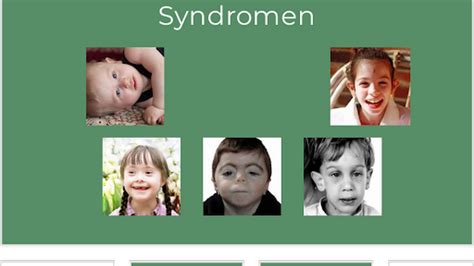 illustratie van een kind met kenmerken van Sotos syndroom, zoals een groter hoofd en lang gezicht