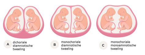 illustratie van een tweelingzwangerschap waarbij één vruchtzakje kleiner is dan het andere
