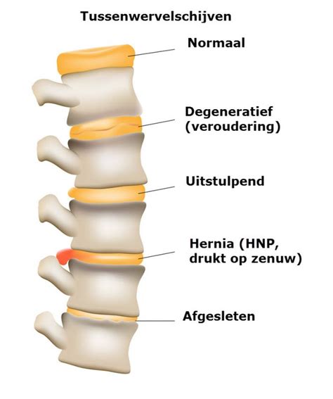 Illustratie van een hernia, met de uitpuilende tussenwervelschijf die op een zenuw drukt.