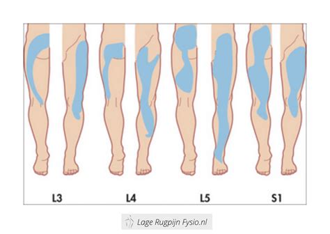Schematische weergave van uitstralende pijn vanuit de onderrug naar het been.