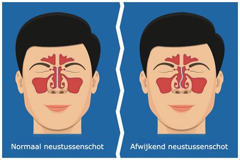 Illustratie van een scheef neustussenschot en de gevolgen voor de luchtstroom