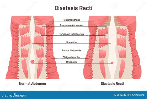 Schematische weergave van diastase recti
