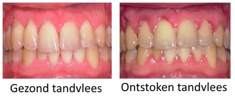 Visuele vergelijking tussen gezond (roze, strak) en ontstoken (rood, gezwollen, bloedend) tandvlees.