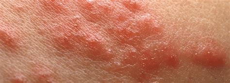 Illustratie van rode bultjes en blaasjes die kenmerkend zijn voor Erythema Toxicum Neonatorum