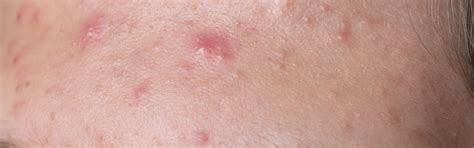 Close-up foto van baby-acne met kleine puistjes op de wangen van een baby