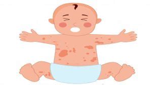 Illustratie die het effect van luieruitslag op de babyhuid toont