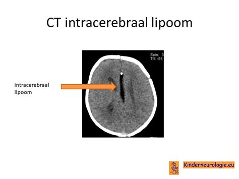 MRI-scan van een intracerebraal lipoom, met witte kleur op T1/T2 opnames