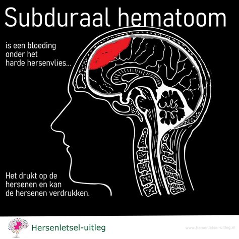 Illustratie van een babyhoofdje met een cephaal hematoom aan de zijkant
