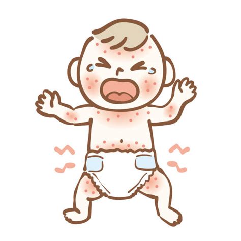 Illustratie van een baby met huiduitslag en huilend, met een icoon van koemelk dat wordt afgewezen.