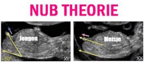Illustratie van de nub theorie, met voorbeelden van de hoek van de nub bij jongens en meisjes op een echografie