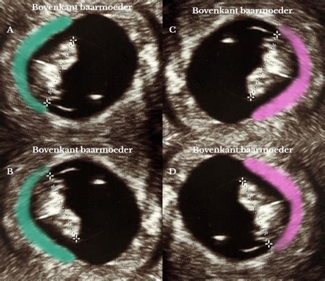 Voorbeelden van echografieën die de Ramzi theorie illustreren, met aanduiding van de placenta locatie en de voorspelde geslacht