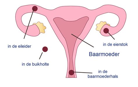 Schematische weergave van een buitenbaarmoederlijke zwangerschap.