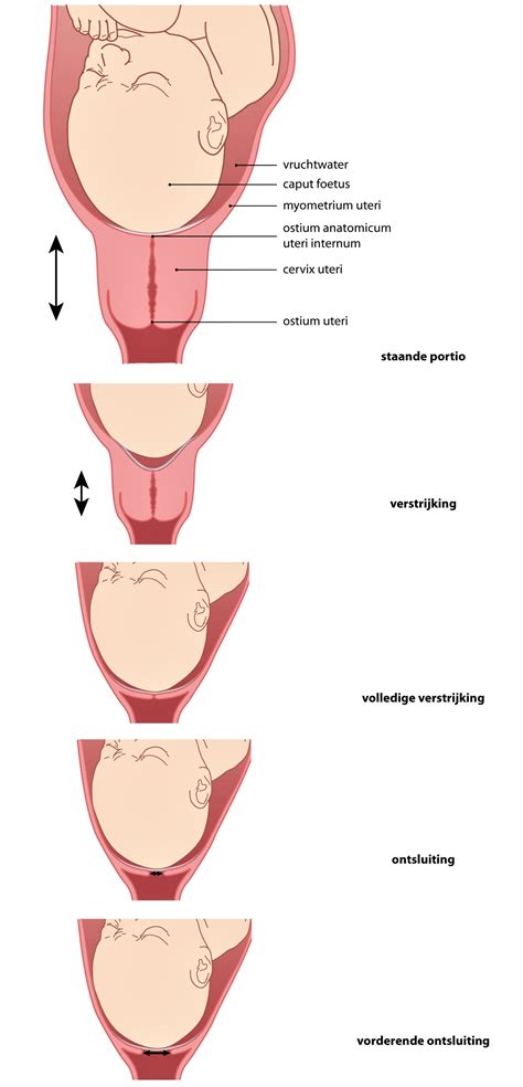 Schematische weergave van de ontsluitingsfase van de baarmoedermond.