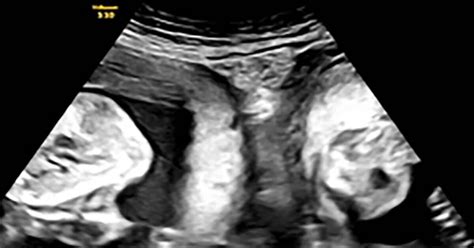 echofoto van een baby in de baarmoeder