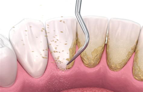 Illustratie van tandplak en tandsteen in de mond.