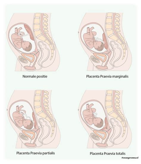 Illustratie van placenta praevia, waarbij de placenta de baarmoedermond bedekt.