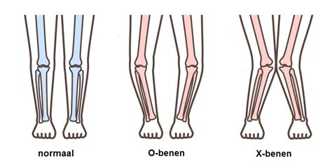 Schema van O-benen naar X-benen naar rechte benen bij kinderen