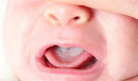 Illustratie van witte plekken op de tong en binnenkant van de wang van een baby, kenmerkend voor spruw.