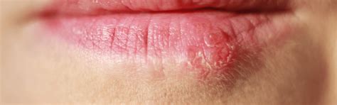 Close-up van een lip met beginnende blaasjes van een koortslip.