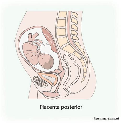 Diagram dat de ligging van de placenta bij placenta previa toont