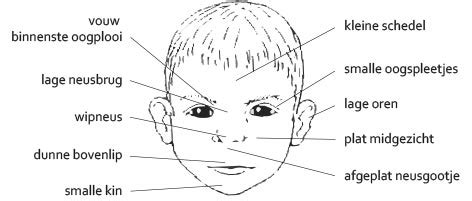 afbeelding van gezichtskenmerken geassocieerd met Foetaal Alcohol Syndroom