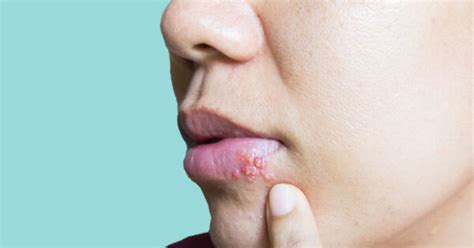 Illustratie van een koortslip op de lip van een kind