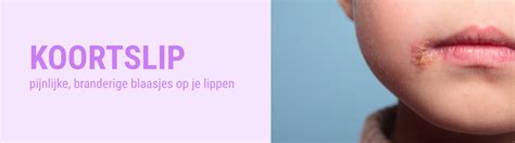Infographic die de verschillende stadia van een koortslip toont: tinteling, blaasjes, openbarsten, korstjes.