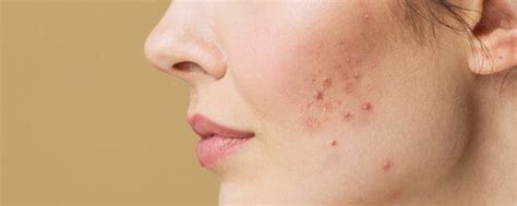illustratie van een baby met milde acne op de wangen