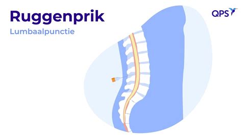 Illustratie van een ruggenprik procedure.
